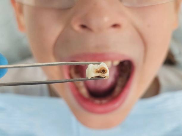 Best Knocked-Out Tooth (Avulsed Tooth) Treatment in Duboistown, PA